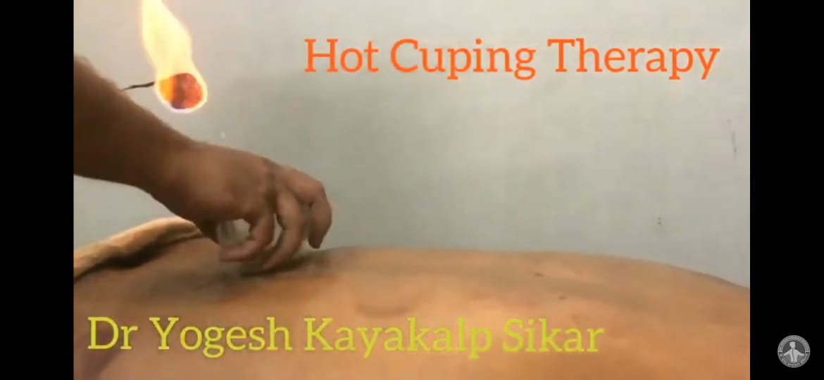 cupping therapy